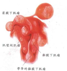 卵巢囊肿为什么会造成女性不孕